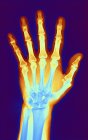Mão de um paciente com osteoartrite — Fotografia de Stock