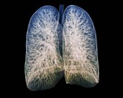 Healthy lungs of a 30 year old patient — Stock Photo