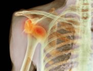 X-ray of dislocated shoulder — Stock Photo