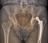 Remplacement disloqué de la hanche — Photo de stock