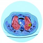 Цветная компьютерная томография (КТ) сканирования участка груди 76-летнего пациента-мужчины со злокачественной (раковой) опухолью (яркой, правой) бронха . — стоковое фото