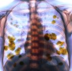 Coloured X-ray of the chest of a 52 year old female patient with metastatic (secondary) lung cancer (yellow). — Stock Photo