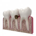 Dentes humanos e sinais de erosão dentária — Fotografia de Stock