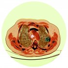 Кольорове комп'ютерне томографічне сканування ділянки через груди 76-річного пацієнта чоловічої статі з злоякісною (скансовою) пухлиною (яскравою, правою) бронха . — стокове фото