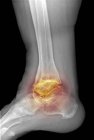 Severe osteoarthritis of ankle — Stock Photo