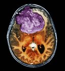 Кольорове комп'ютерне томографічне сканування мозку 25-річного пацієнта з менінгомою (синім ). — стокове фото