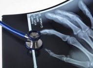 Röntgenbild der Handknochen — Stockfoto