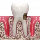 Dental plaque pathology — Stock Photo