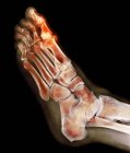 Deformación degenerativa del pie, rayos X - foto de stock