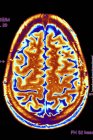 Ressonância magnética colorida (MRI) varredura de uma seção axial através de um cérebro saudável . — Fotografia de Stock