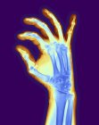 Hand of a patient with osteoarthritis — Stock Photo