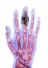 Іноземне тіло в пальці — стокове фото