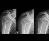 Radiografías del hombro derecho de un paciente de 36 años que ha dislocado repetidamente la articulación . - foto de stock