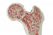 Fracture du cou du fémur — Photo de stock