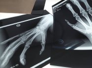Imagen de rayos X de huesos de la mano - foto de stock