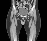 Tomografía computarizada (TC) de la vejiga llena sana (óvalo) de un paciente de 45 años . - foto de stock