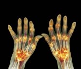 Ревматоидный артрит рук — стоковое фото