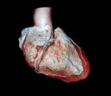 Coração de um paciente de 54 anos — Fotografia de Stock