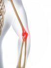 Focus of inflammation localized in elbow joint — Stock Photo