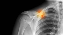 Coloured X-ray of a 16 year old male with a fractured clavicle (collar bone). — Stock Photo