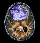 Tomodensitométrie (TDM) colorée du cerveau d'un patient de 25 ans atteint d'un méningiome (bleu ). — Photo de stock
