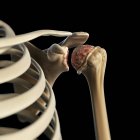 Rendement visuel de l'épaule arthritique — Photo de stock