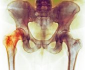 Хіп перед операцією на заміну кульшового суглоба, рентген — стокове фото