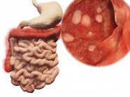 Colitis ulcerosa, ilustración por computadora . - foto de stock