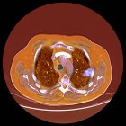 Кольорове комп'ютерне томографічне сканування ділянки через груди 76-річного пацієнта чоловічої статі з злоякісною (скансовою) пухлиною (яскравою, правою) бронха . — стокове фото