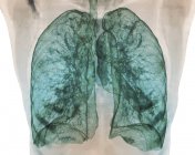 Colored computer tomography scan of healthy lungs. — Stock Photo