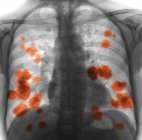 Radiographie colorée de la poitrine d'une patiente de 52 ans atteinte d'un cancer du poumon métastatique (secondaire) (jaune) ). — Photo de stock