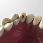 Visualização da cárie dentária — Fotografia de Stock