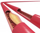 Arteriosklerose und verengte Arterie — Stockfoto