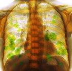 Radiographie colorée de la poitrine d'une patiente de 52 ans atteinte d'un cancer du poumon métastatique (secondaire) (jaune)
). — Photo de stock