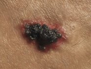 Pathologie du cancer de la peau — Photo de stock