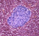 Carcinoma mammario metastatico — Foto stock