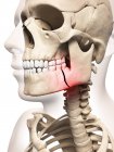 Osso da mandíbula partido — Fotografia de Stock