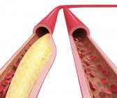 Anatomía patológica de la aterosclerosis - foto de stock
