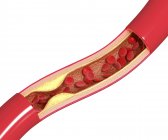Cholesterin-Plaque führt zu Arteriosklerose — Stockfoto