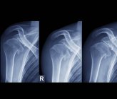 Цветные рентгеновские снимки правого плеча 36-летнего пациента, который неоднократно вывихивал сустав . — стоковое фото