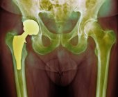 Total hip replacement, — Stock Photo