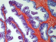 Рак предстательной железы — стоковое фото