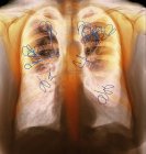 Эндобронхиальные клапаны, приспособленные для лечения туберкулеза — стоковое фото