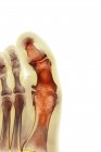 Deformação degenerativa do pé — Fotografia de Stock