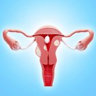 Anatomie pathologique du cancer de l'utérus — Photo de stock