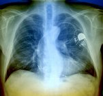 Paziente con pacemaker cardiaco — Foto stock