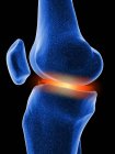 Inflamed knee cartilage — Stock Photo