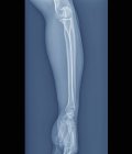 Normale Ellenbogen- und Handgelenke, Röntgenbild — Stockfoto