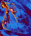 Angiografía coronaria coloreada (radiografía) de un paciente de 59 años con estenosis grave (estrechamiento) en la arteria coronaria interventricular anterior izquierda (descendente izquierda) y la arteria circunfleja izquierda (centro) ). - foto de stock