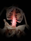 Inflammation of human spine — Stock Photo